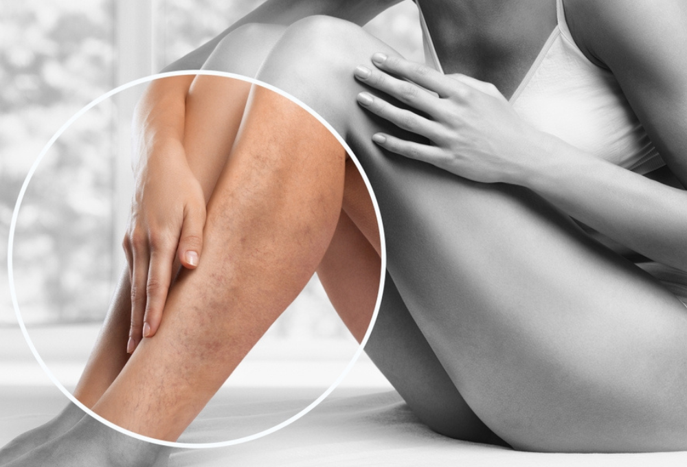 Lipedema e varizes podem acontecer juntos? Entenda a relação com a circulação